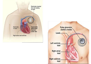 Dual chamber Pacemaker